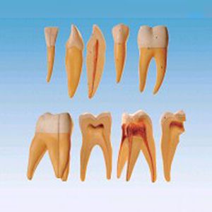 Tooth amplification model